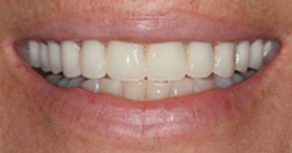Before treatment